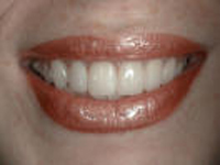 Teeth are important to proprioception
